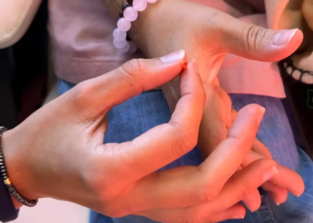 Acupuncture and nutrition approach shown by a needle being applied to a pressure point on the hand.