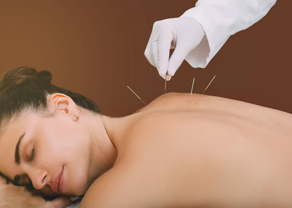 Trigger point acupuncture session with a woman receiving needle treatment along her upper back