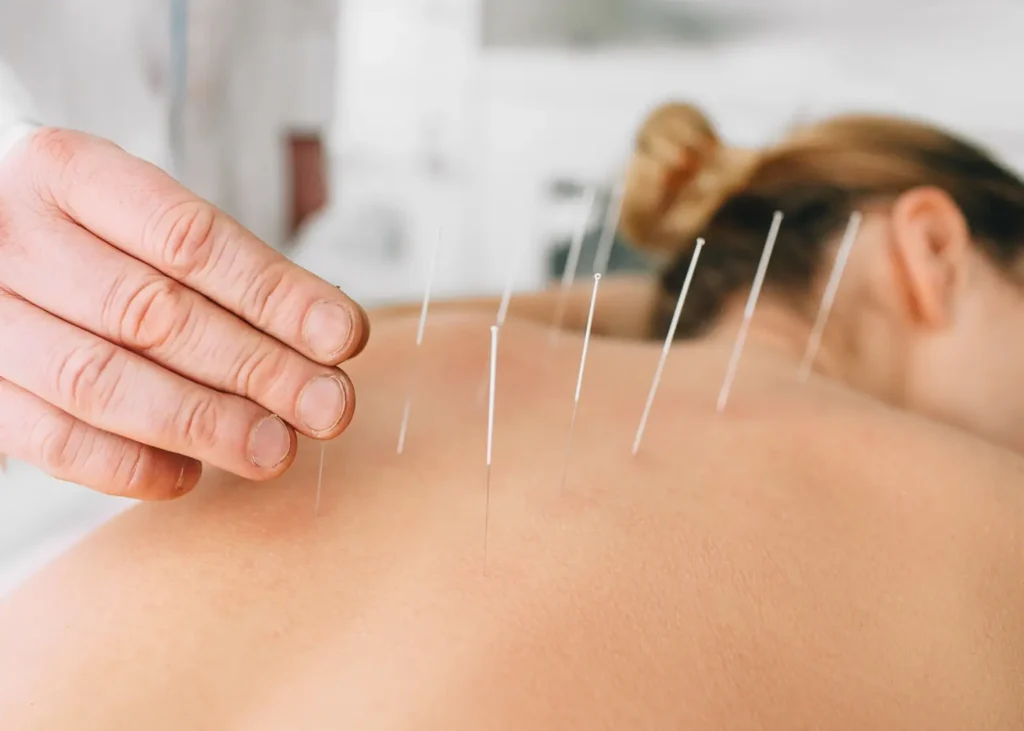 Trigger point therapy using acupuncture needles applied to a patient's back for muscle pain relief
