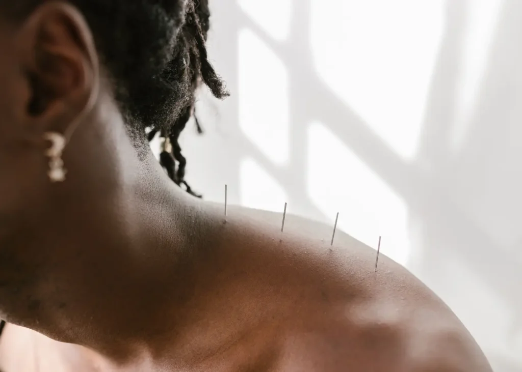 Acupuncture benefits for pain management shown with needles inserted into a person's shoulder and upper back