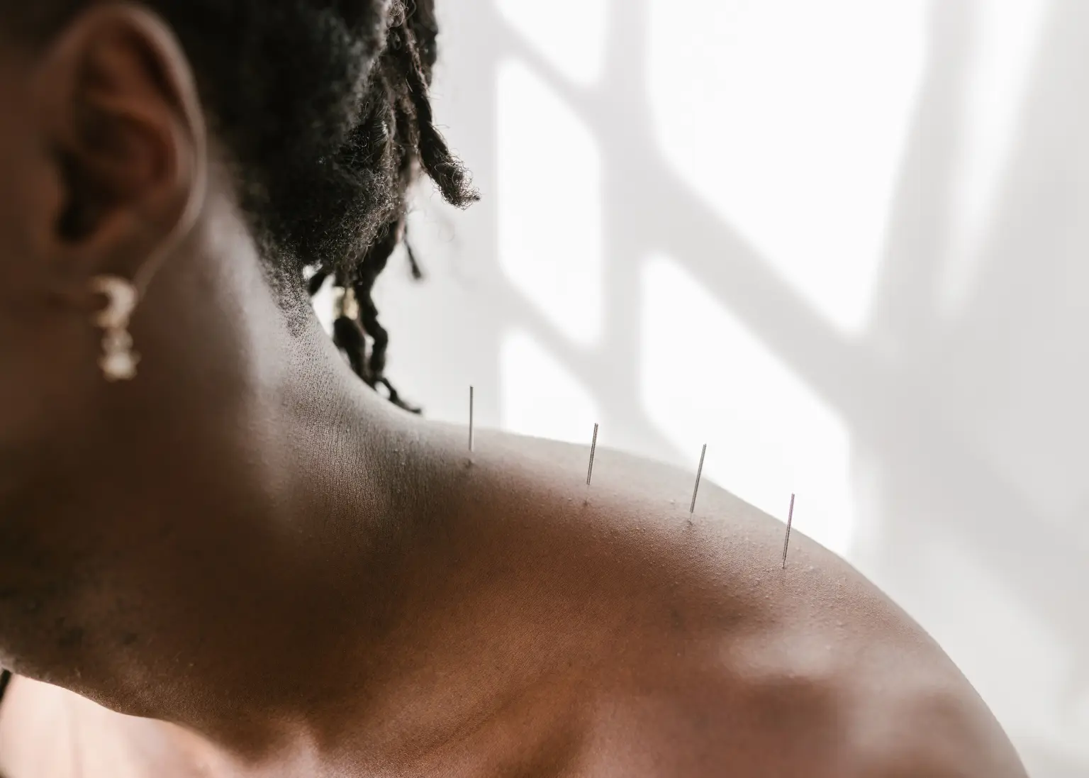 Acupuncture benefits for pain management shown with needles inserted into a person's shoulder and upper back.