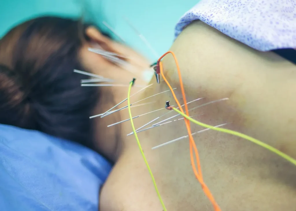 Acupuncture wellness routine being performed on a woman’s back with multiple needles and a practitioner using a tool.
