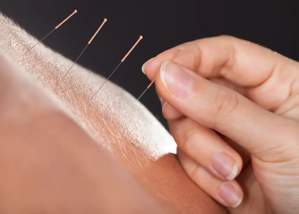 Acupuncture therapy hand inserting copper needle into skin during traditional healing session