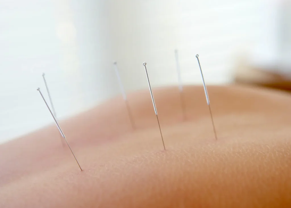 Dry needling therapy close-up of fine needles placed in skin for muscle tension treatment
