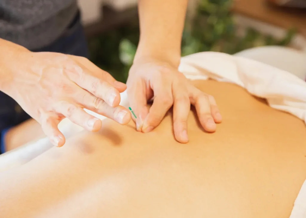 Trigger point therapy practitioner inserting thin needle into patient’s back for muscle pain relief